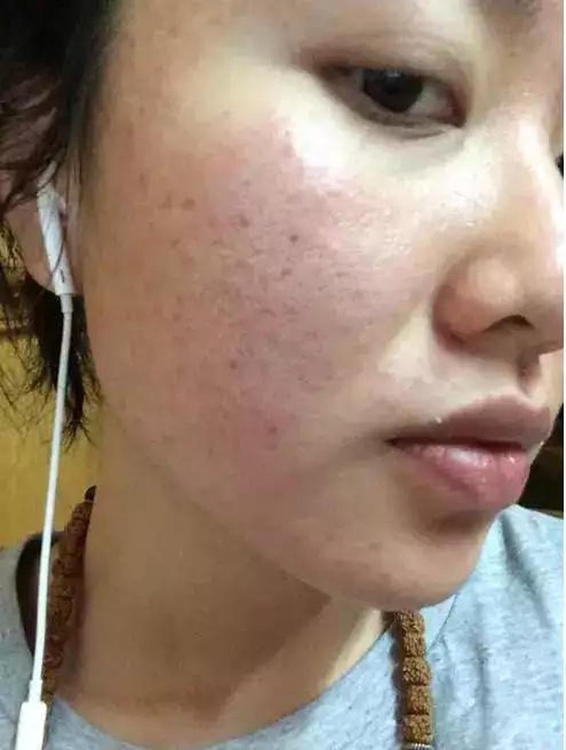 怎样揉痘痘的 *** —痘痘瞬间爆破 *** -第1张图片-情感驿站