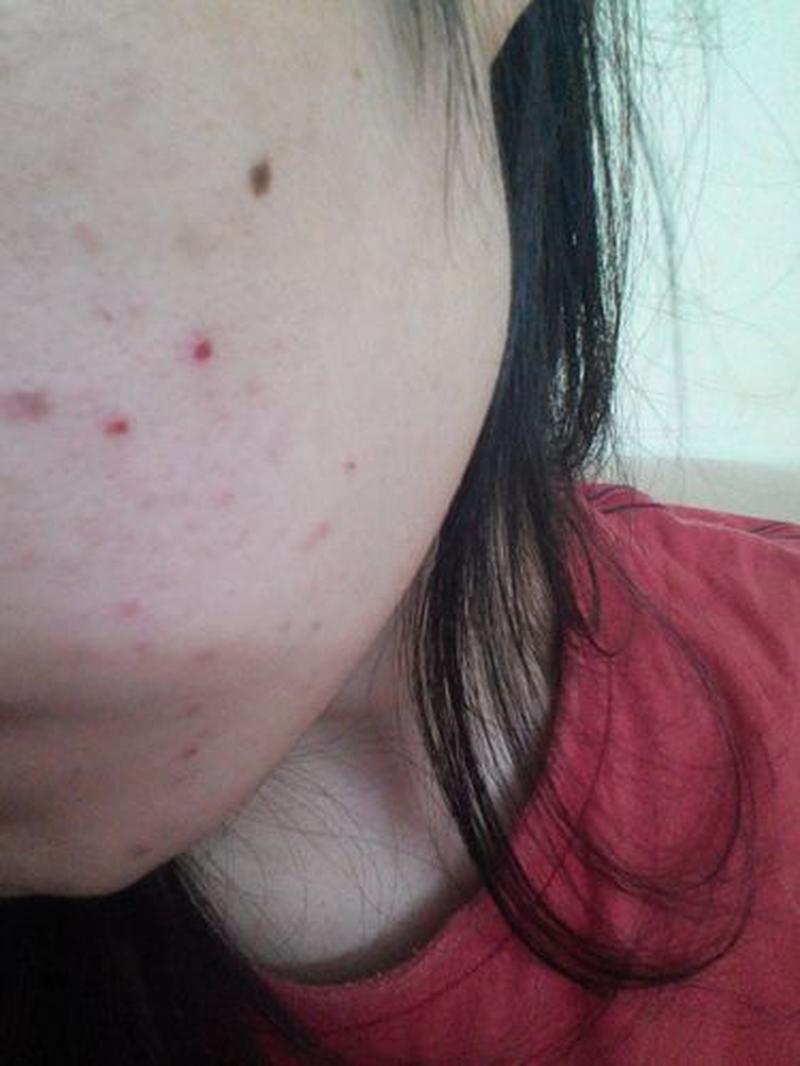 男朋友突然会按我的小痘痘了_男友突袭痘痘王国,意外引爆惊喜-第1张图片-情感驿站 男朋友突然会按我的小痘痘了_男友突袭痘痘王国,意外引爆惊喜-第1张图片-情感驿站