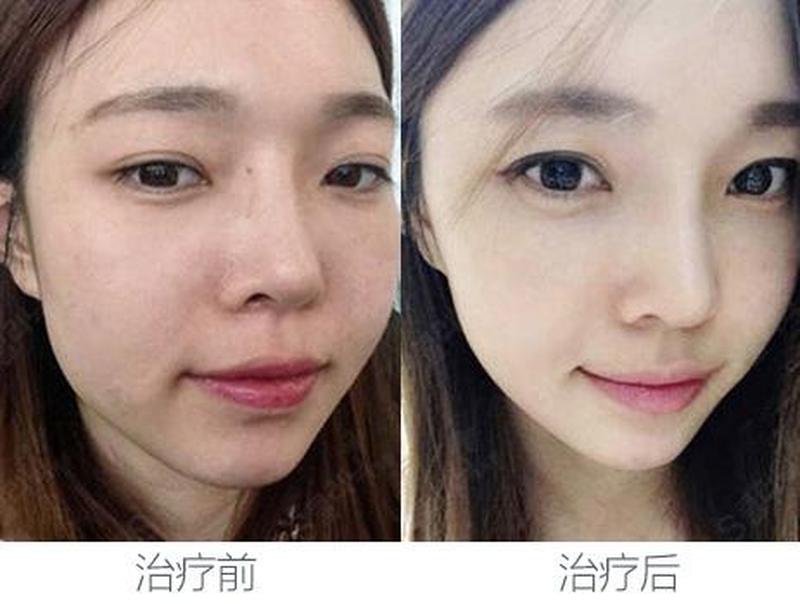 水融：肌肤融合术，重焕水盈光泽-第1张图片-情感驿站