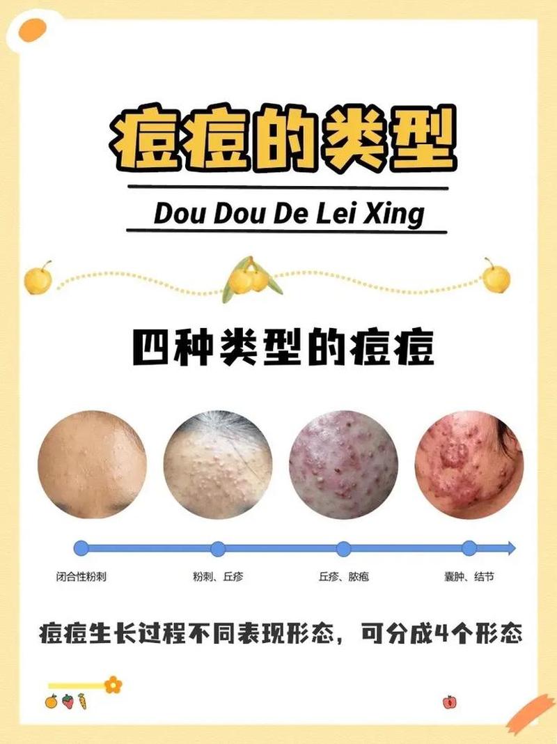 男朋友很会玩我的痘痘(爱痘如痘”，男友的手术刀)-第1张图片-情感驿站