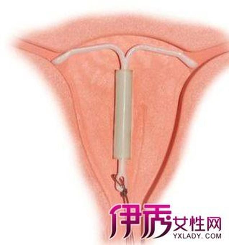 女人带环过程_女性带环,开启安心的生育旅程-第1张图片-情感驿站 女人带环过程_女性带环,开启安心的生育旅程-第1张图片-情感驿站