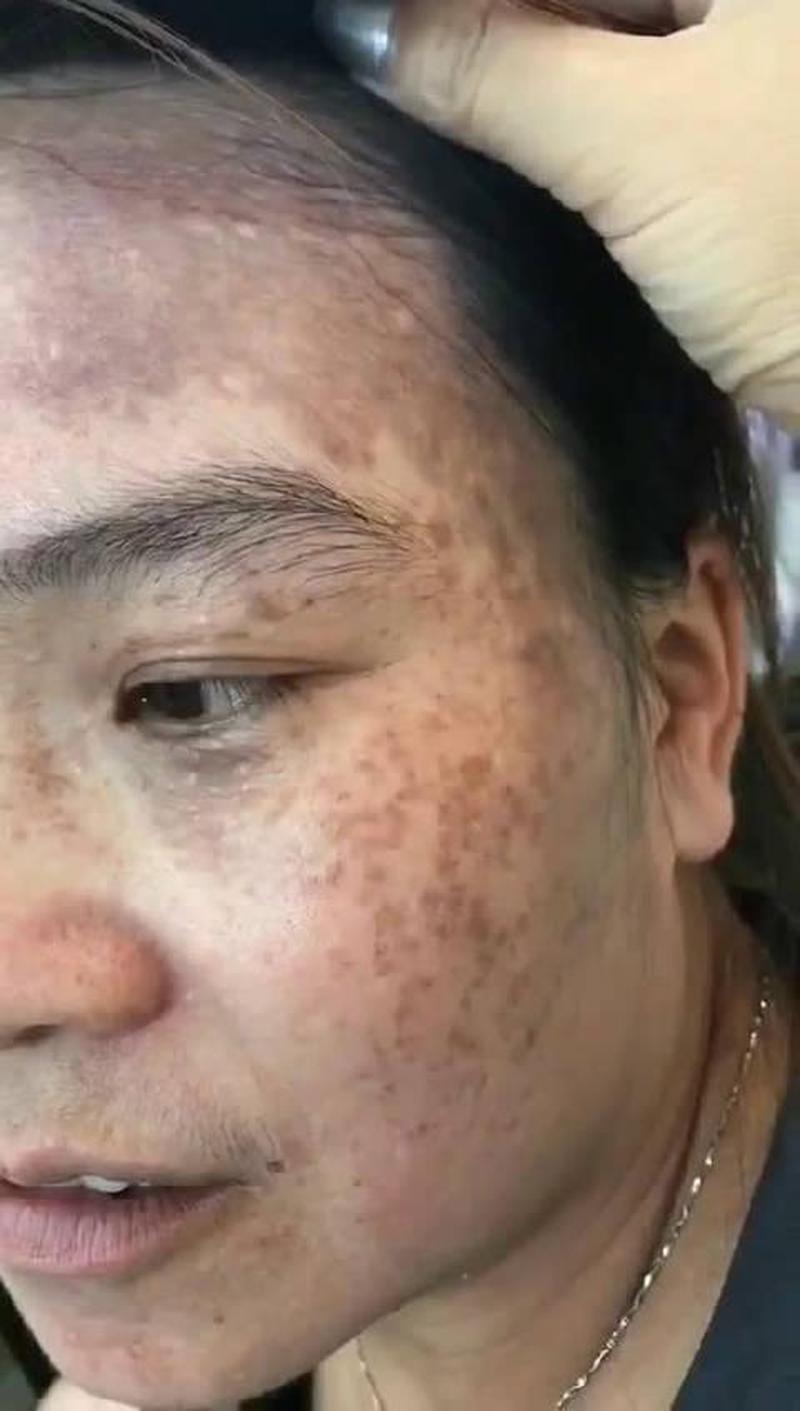 额头两边长黑斑是怎么回事_额头两侧黑斑：揭秘其成因和消除妙招-第1张图片-铖浩科技