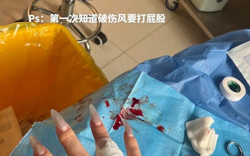  死亡冰手指(死亡冰手指形成原理)