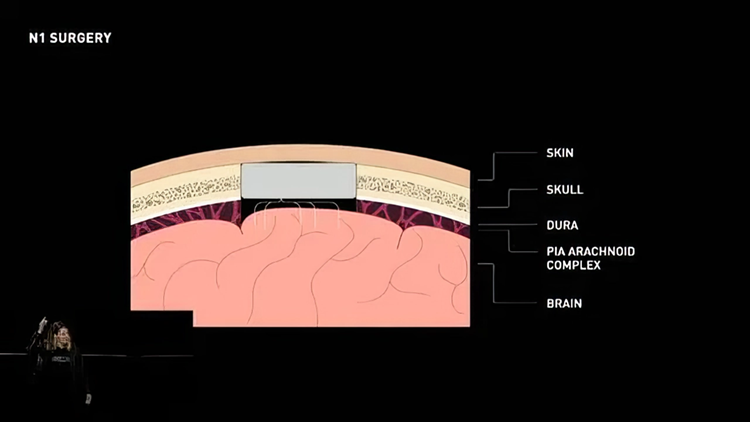 马斯克Neuralink首位受试者康复，能意念控鼠标，但安全性仍有待观察-第3张图片-科技快讯
