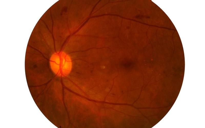 配资炒股行情发育性青光眼-第1张图片-金银屋