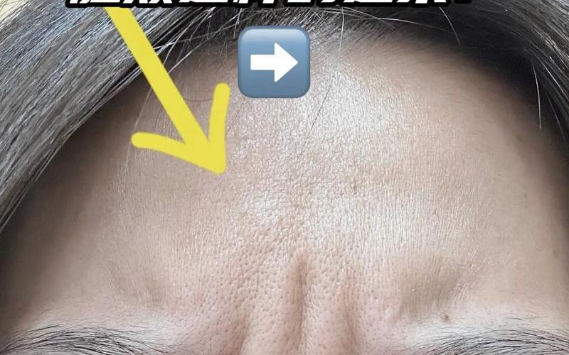 草莓鼻是什么;草莓鼻是什么病