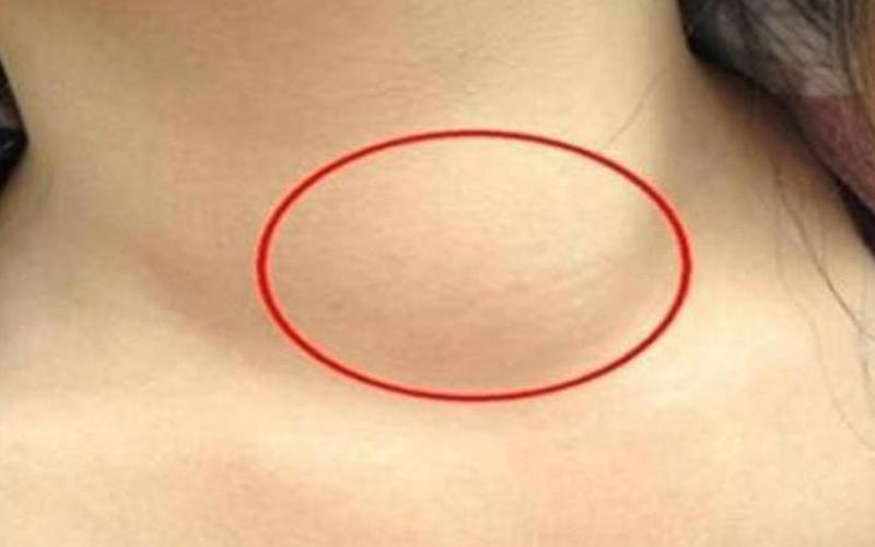 脖子上长痘痘-脖子上长痘痘是艾滋病前兆吗